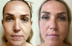 Injectable and Fillers Patient in Houston, Texas by Kronowitz Plastic Surgery