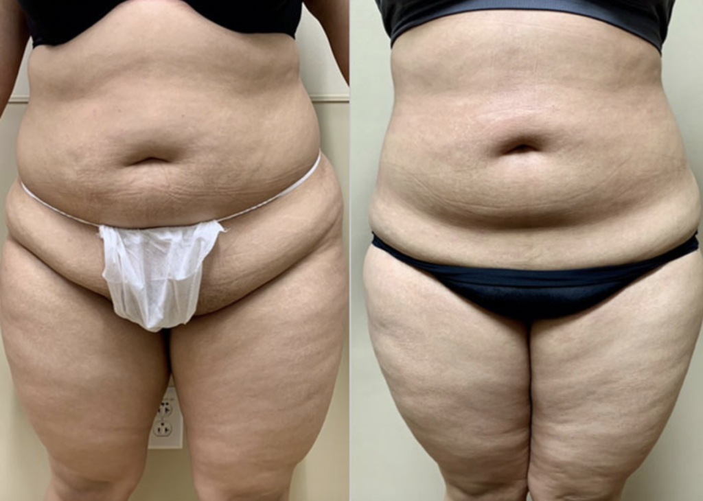  Liposuction patient before and after image in Houston, TX