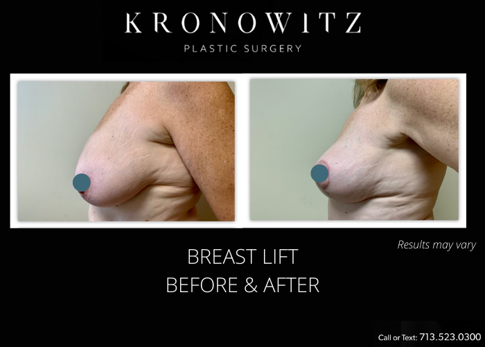 Before and after image showing the results of a breast lift performed in Houston, TX.