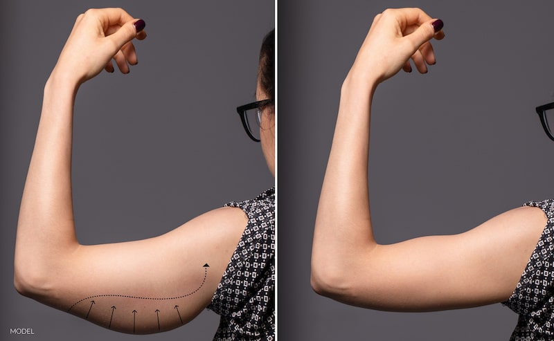 Arm lift - before and after.