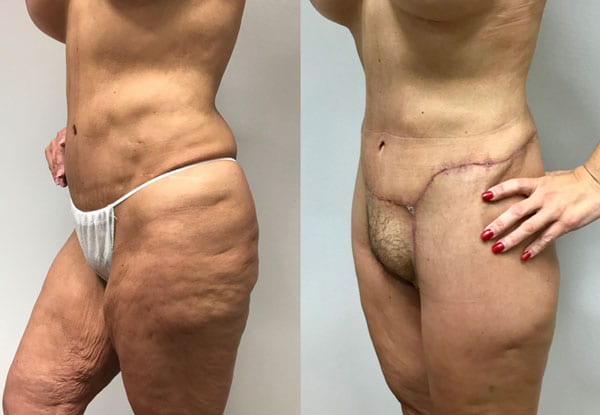 Before and after lower body lift in Houston, TX