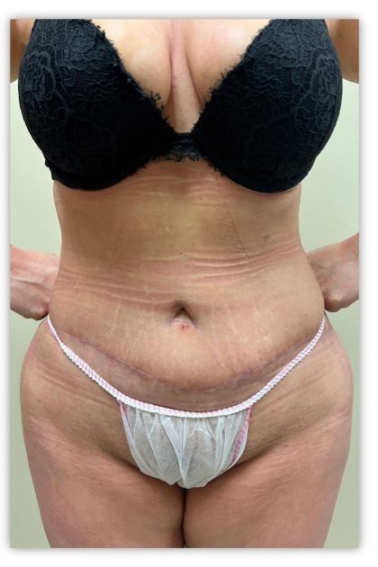 Study Confirms What Women Know: Tummy Tuck + Liposuction = Extreme  Satisfaction - Houston, Texas