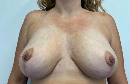 Breast Reduction Before & After Patient #4206